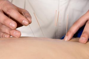Acupuncture in Goodyear & Mesa